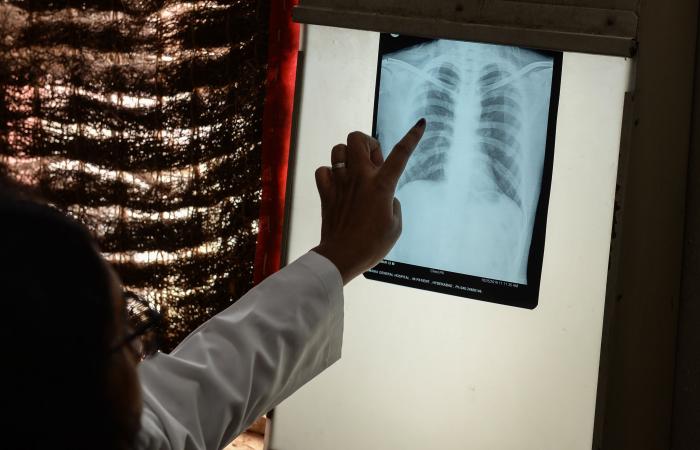 World
      Health
      Organization
      warns
      of
      possible
      tuberculosis
      surge
      because
      of
      USAID
      cuts - Iqraa news